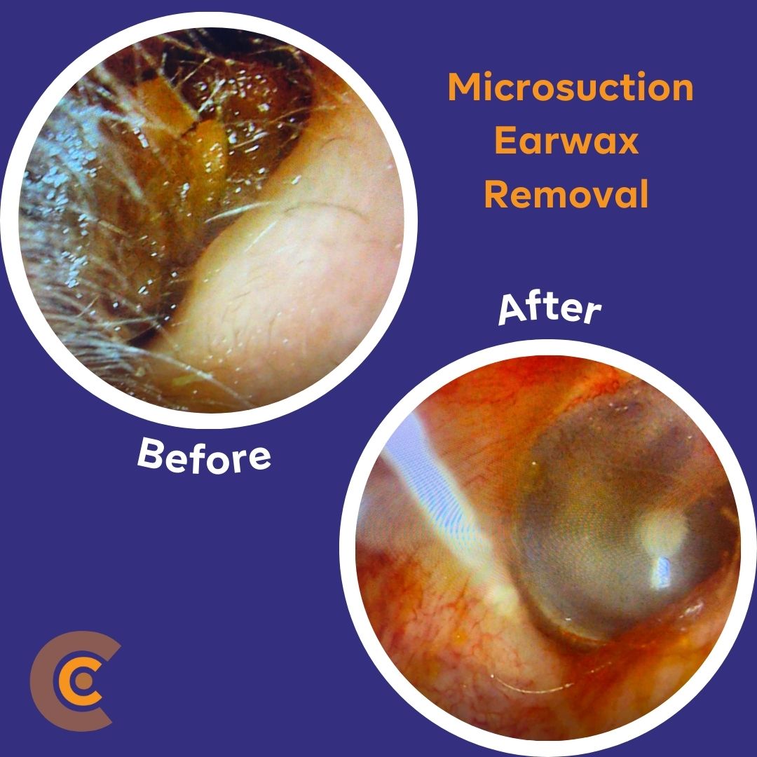 Ear Wax Removal - Audio Care
